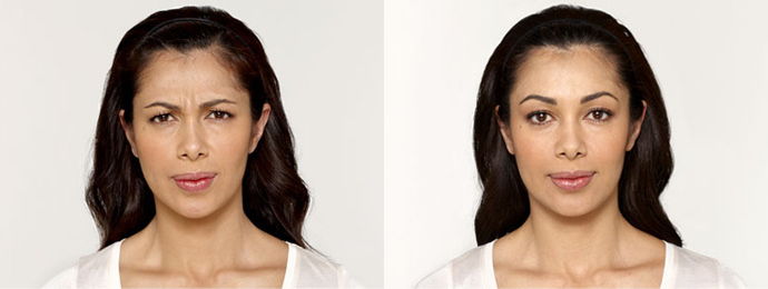 Botox Cosmetic - Before and after